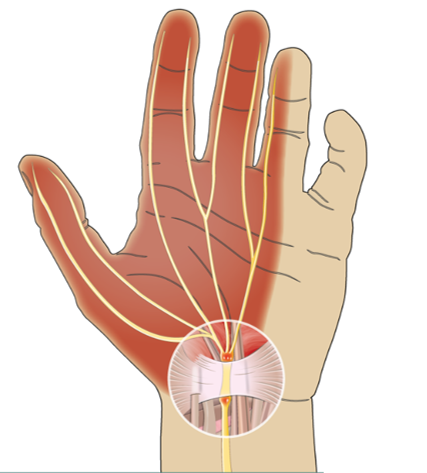 Everything You Need To Know About Carpal Tunnel Syndrome — Sarrica